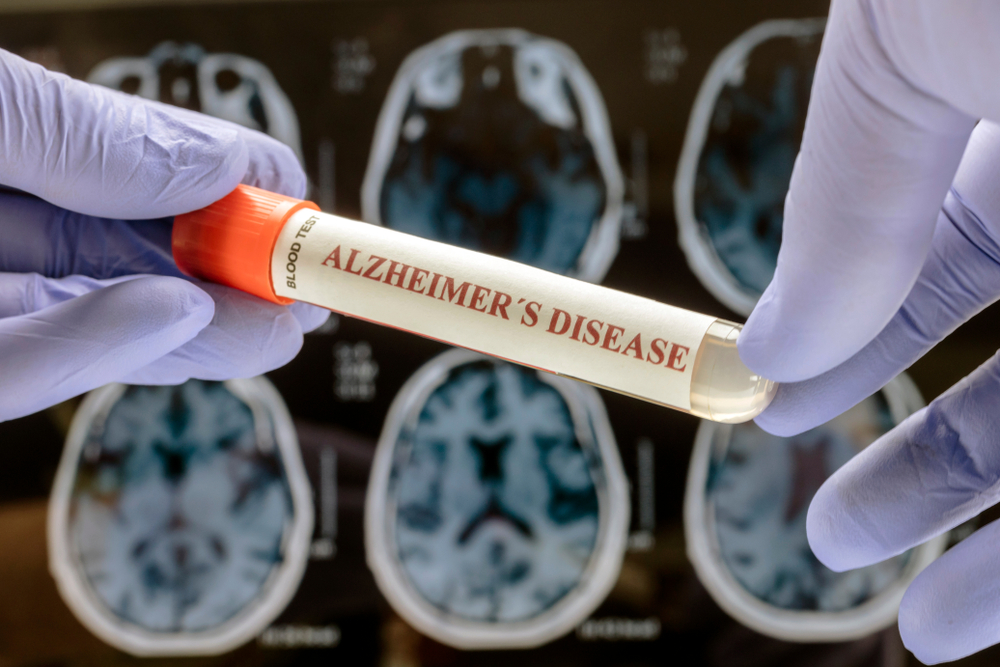 Groundbreaking Study Shows NAD⁺ Restores Memory in Alzheimer’s Models