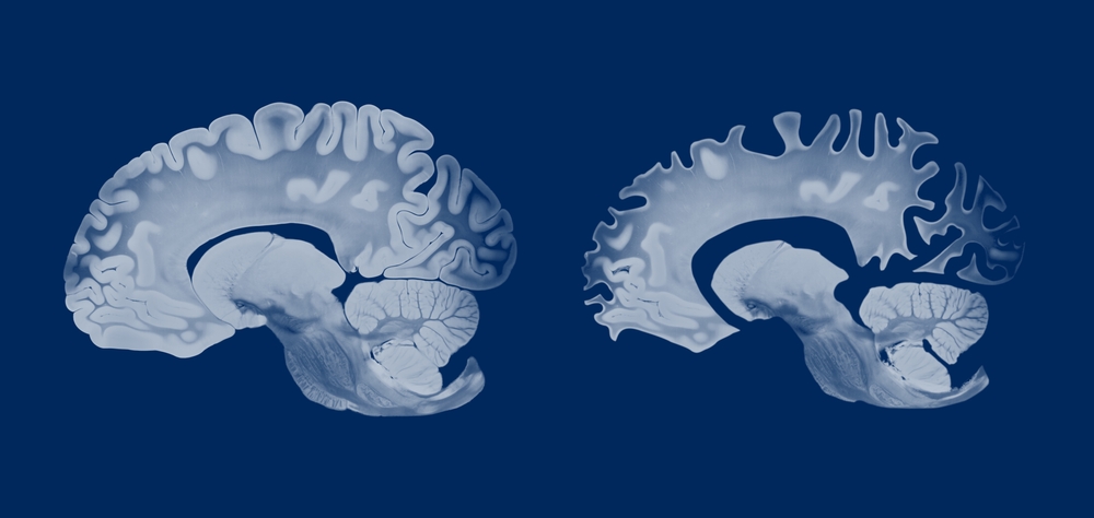 Research Links NAD+ Decline to Alzheimer’s Disease