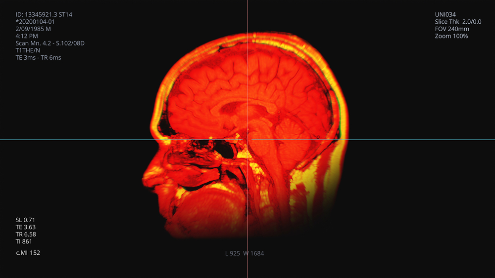 Could NAD Serve as a Biomarker for Stroke Recovery?
